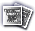 Treatment Images to be added